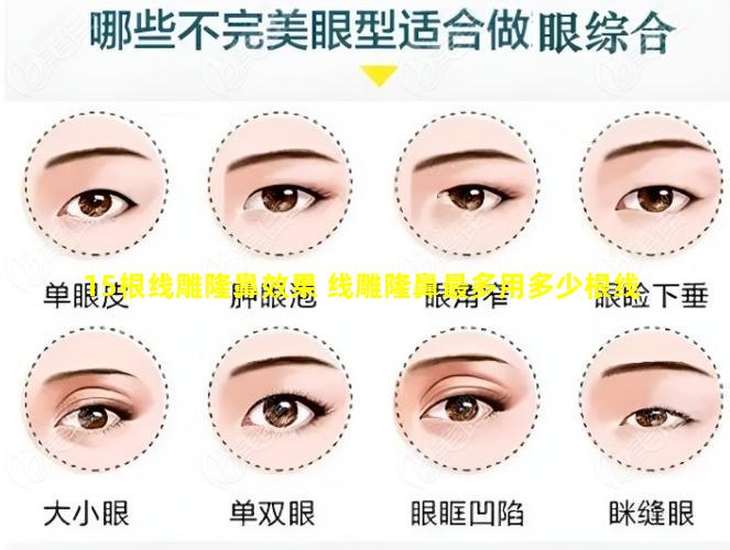 15根线雕隆鼻效果 线雕隆鼻最多用多少根线